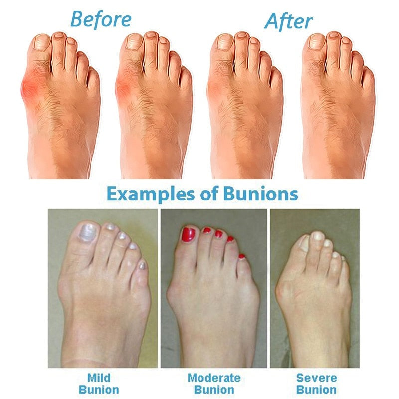 Isadora | Women's supportive Bunion Corrector Sandals